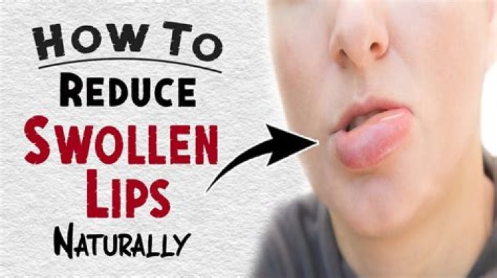 What helps a swollen lip from food allergies?